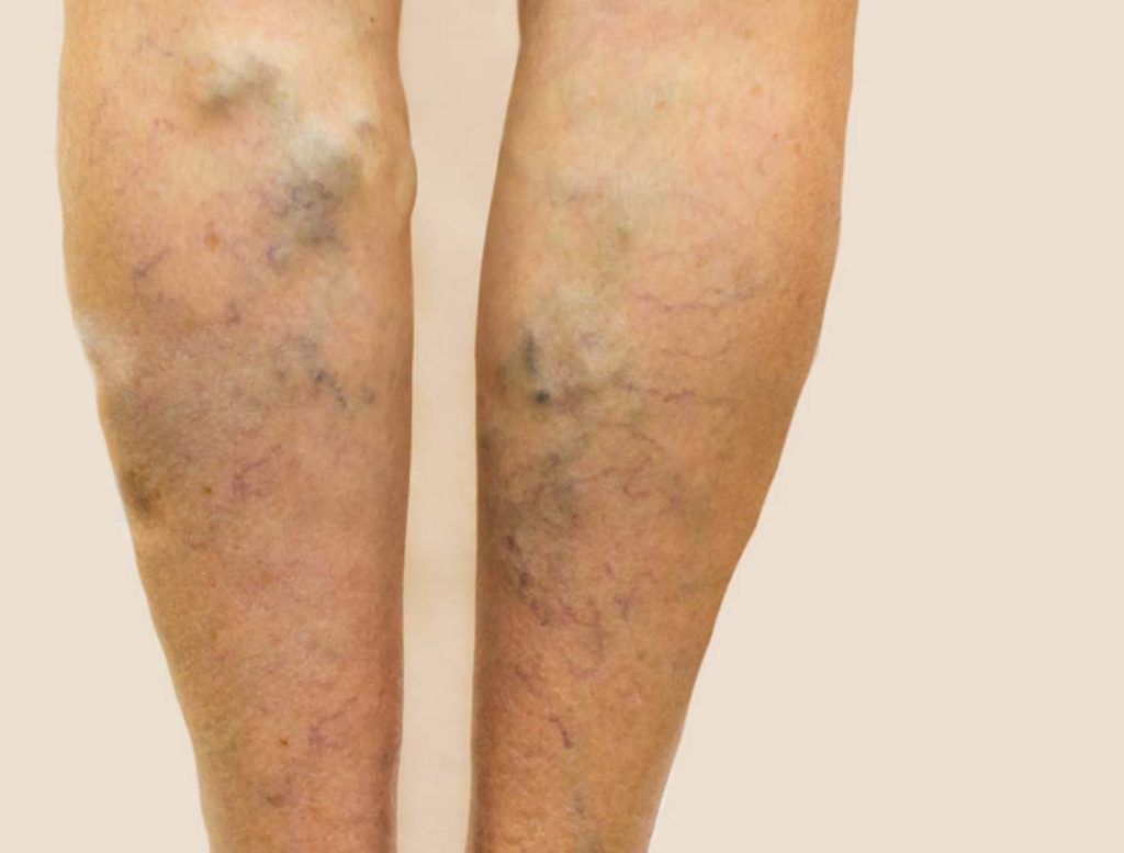 person with varicose veins