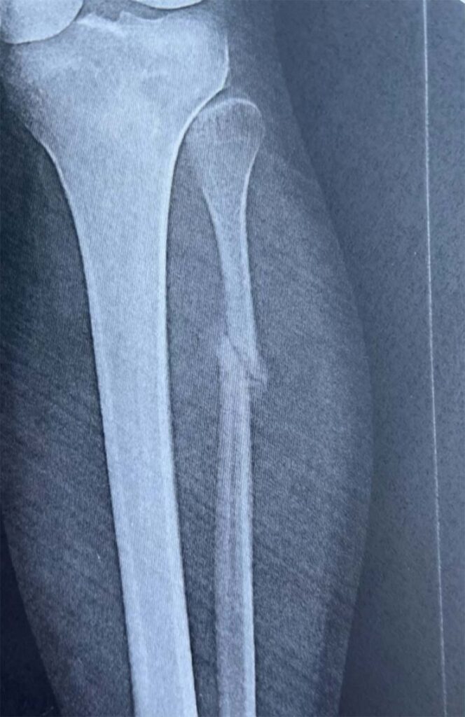 x-ray of fibula oblique fracture