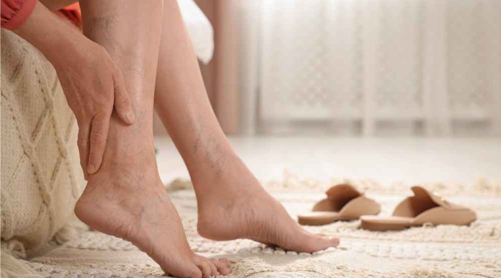 woman with varicose veins
