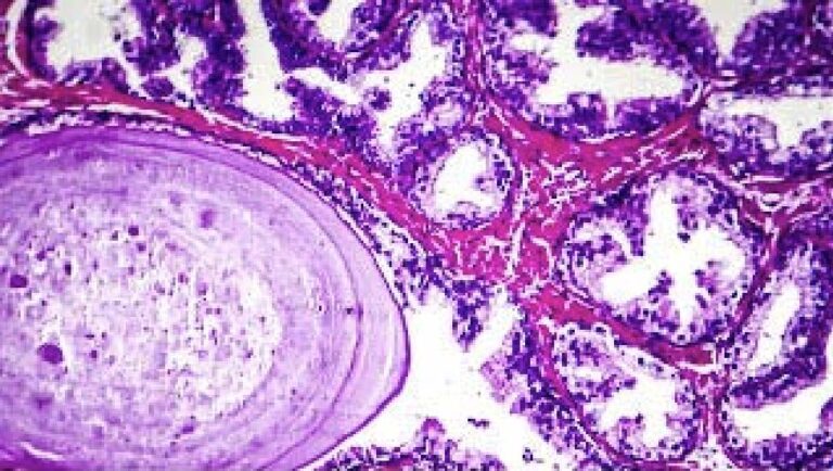 histopathology of prostate gland hyperplasia